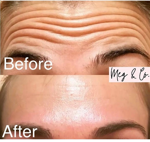 Discover The Benefits Of A Botox Procedure At Meg Co Aesthetics