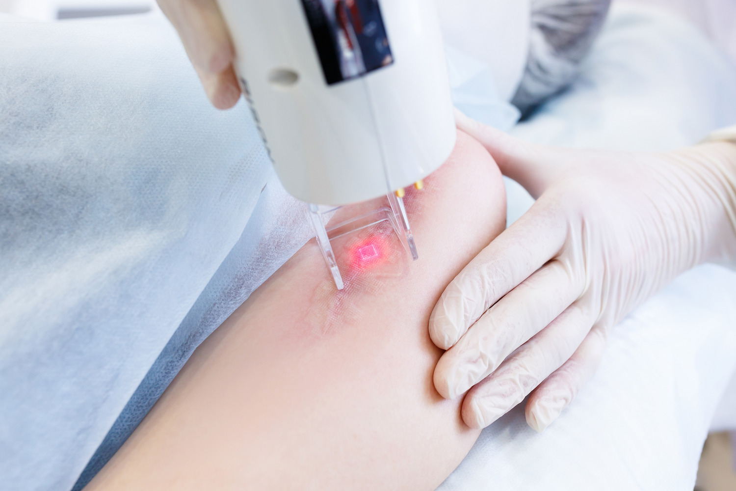 What Is Laser Scar Removal and Why Do You Need It?