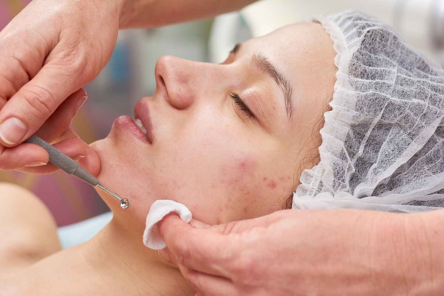 What Are The Types Of Acne?