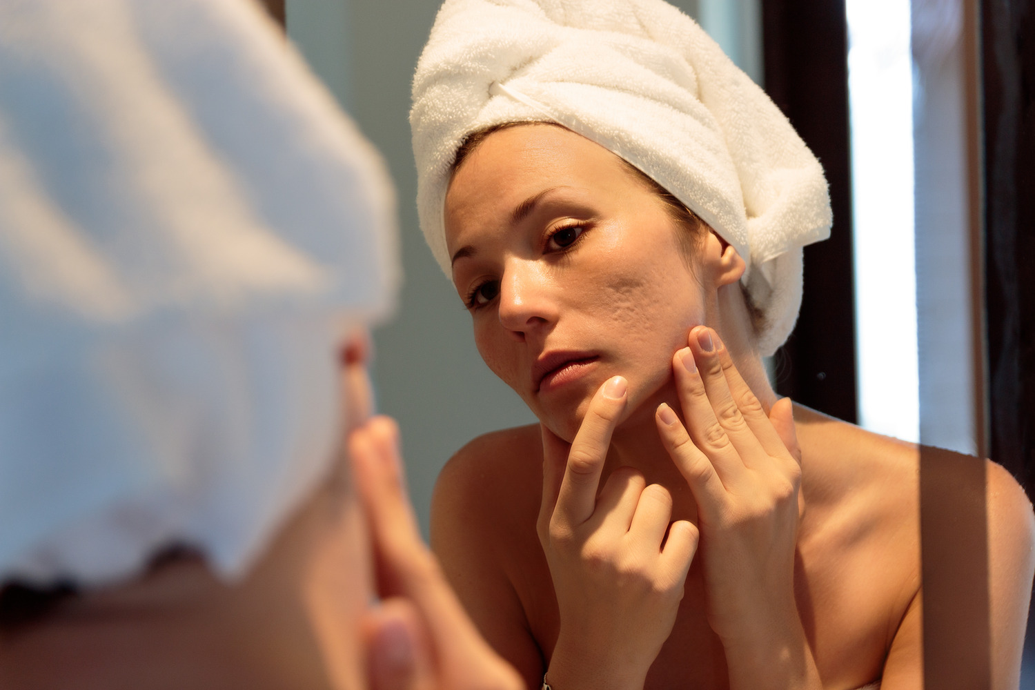 What Are Acne Scars and What Causes Them?