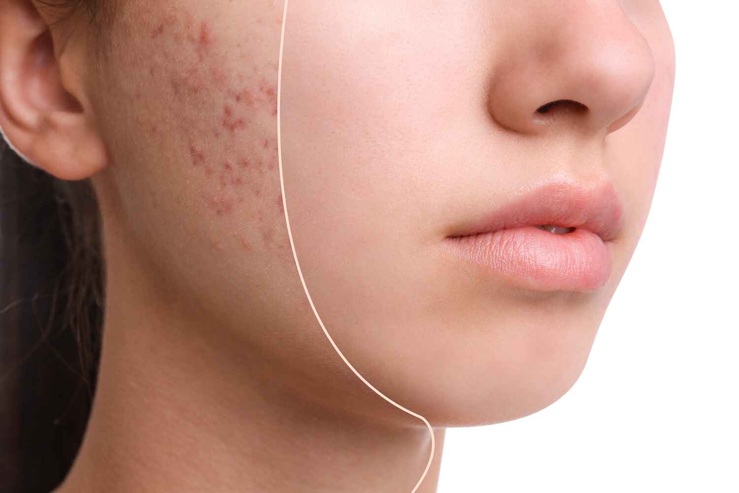 AdobeStock_317276562 What Is Acne and What Causes It?