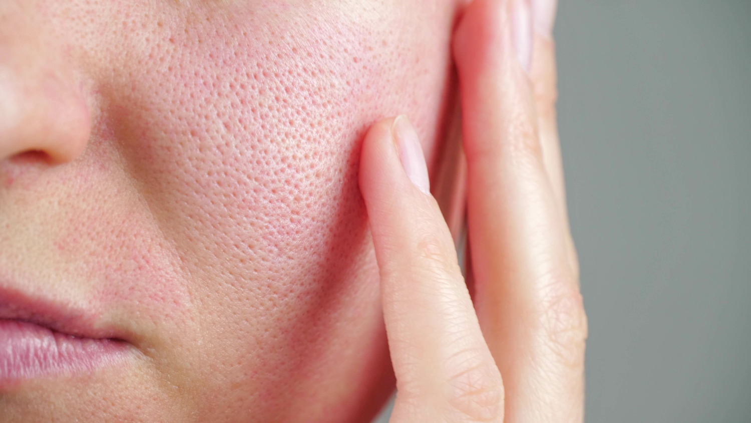 Enlarged Pores vs. Acne Scars